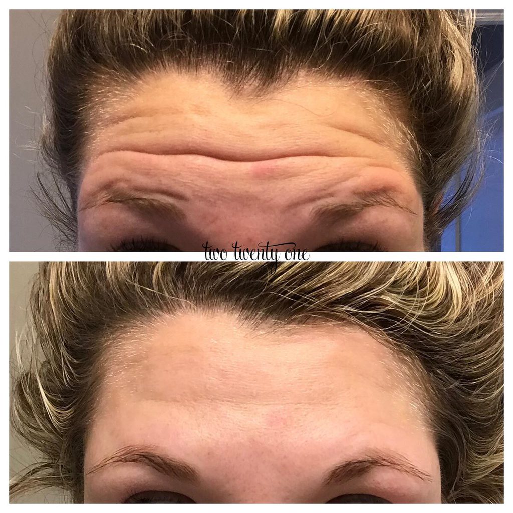 Botox Before and After - My Botox Experience